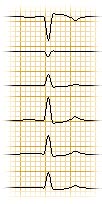 EKG-Kurve